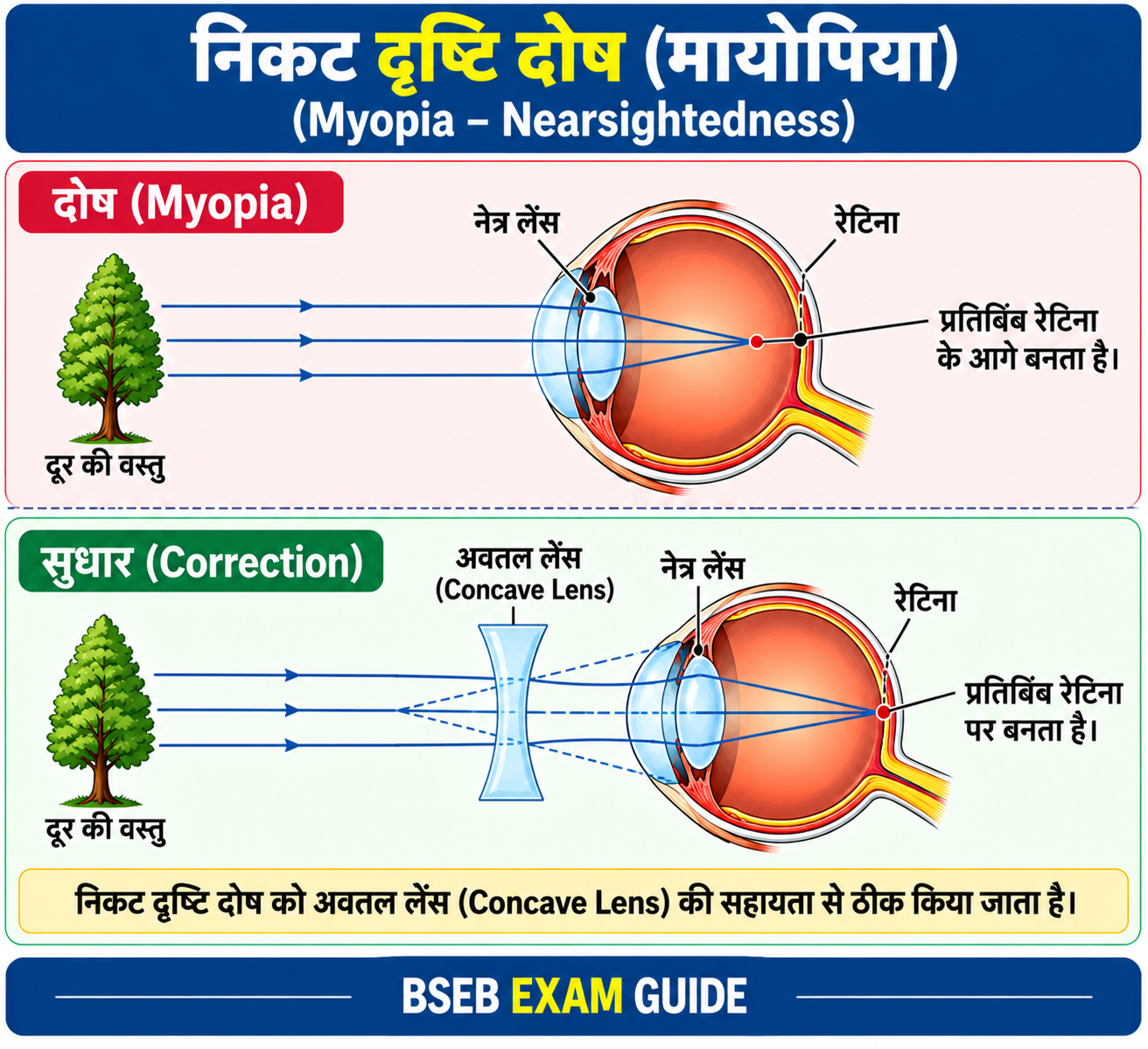 निकट दृष्टि दोष Myopia और उसका सुधार